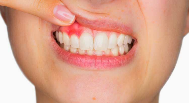 Gingivitis: Its Symptoms, Causes and Treatment